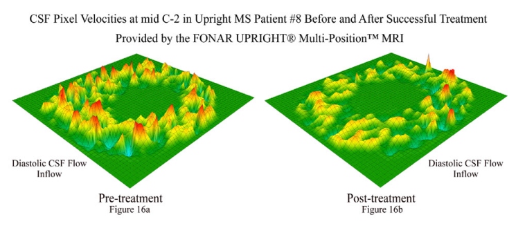 CSF Pixel Velocities at mid C-2 in Upright MS Patient #8 Before and After Successful Treatment